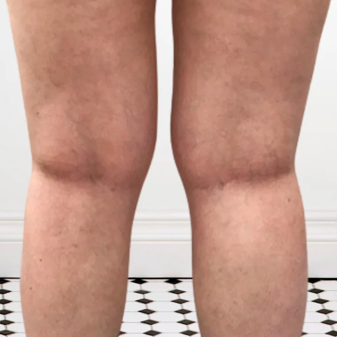 Leg Vein Rescue™ Supplements For Varicose Veins, Venous Insufficiency